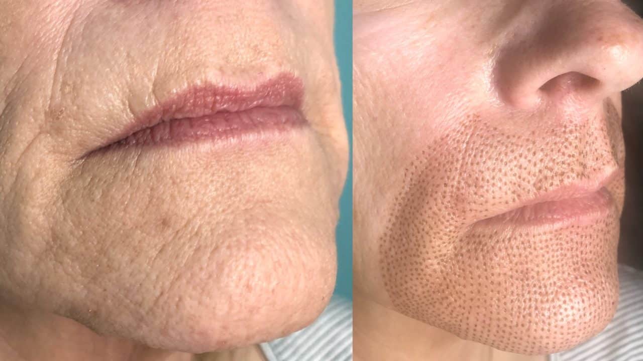 Fibroblast Plasma Skin Tightening Hm Advanced Skin And Lash Spa